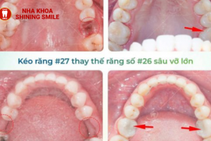 Niềng Kéo Răng 7 và 8: Quy Trình và Đánh Giá