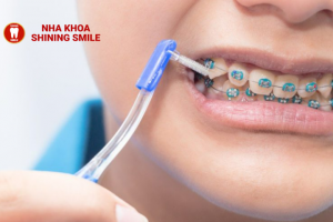 Giải Pháp Khi Vít Niềng Răng Bị Lung Lay: Nguyên Nhân và Cách Khắc Phục