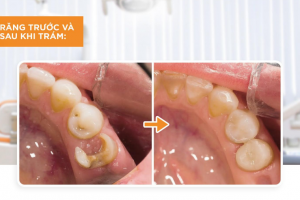 Răng Trám Có Thể Niềng Được Không? Giải Đáp Từ Chuyên Gia