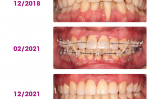 Răng Yếu Có Thể Niềng Được Không? Giải Đáp Từ Chuyên Gia