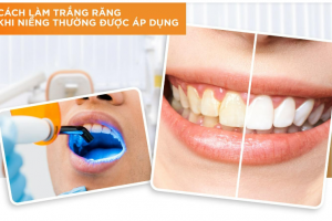Cách Làm Trắng Răng Khi Niềng: Mẹo Và Phương Pháp An Toàn