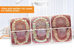 Răng Như Thế Nào Thì Nên Niềng? Tư Vấn Từ Nha Sĩ