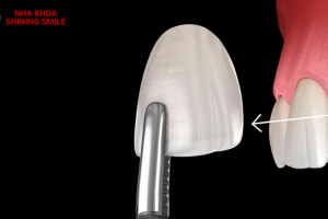 Tháo Răng Sứ Có Đau Không? Những Điều Cần Lưu Ý