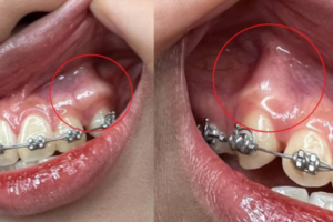 Chi Phí Niềng Răng Khểnh: Bảng Giá và Lựa Chọn Phù Hợp
