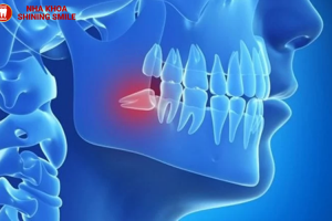 Trồng Răng Số 8: Có Nên Thực Hiện? Chuyên Gia Tư Vấn!