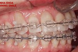 Cách xử lý bị tụt lợi khi niềng răng