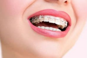 Niềng răng mắc cài sứ là gì? Ưu và nhược điểm mắc cài sứ