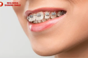 Giá Niềng Răng Thưa Hàm Trên: Thông Tin Chi Tiết Và Lựa Chọn!