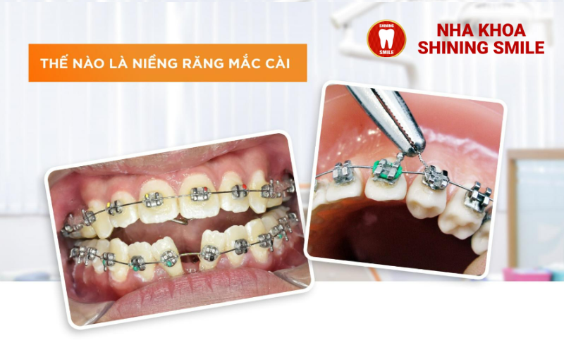 Kinh Nghiệm Niềng Răng: Lời Khuyên Từ Người Trong Cuộc