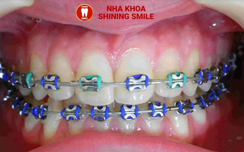 Niềng Răng Bị Sưng Lợi: Nguyên Nhân và Cách Xử Lý Hiệu Quả