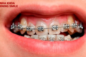 Các Giai Đoạn Niềng Răng: Hành Trình Đến Nụ Cười Hoàn Hảo