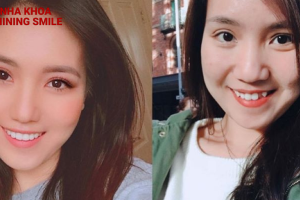 Góc nghiêng hoàn hảo của người niềng răng