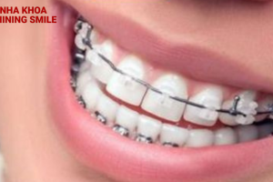 Niềng răng móm bao nhiêu tiền: Mức giá mới nhất 2024