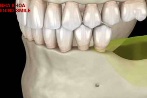 Mất răng có niềng răng được không?