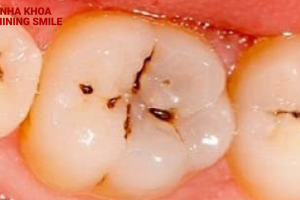 Răng sâu có niềng được không?