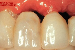 Cách khắc phục nếu thấy dấu hiệu tiêu xương răng khi niềng