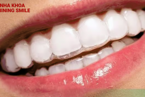 Những điều có thể bạn chưa biết về chi phí nẹp răng