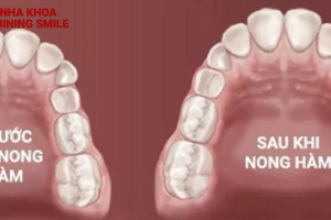 Tất Tần Tật Về Nong Hàm Khi Niềng Răng: Giải Pháp Hiệu Quả Từ SHINING SMILE