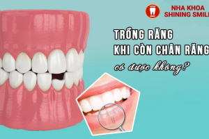Còn Chân Răng Có Trồng Răng Được Không? Giải Pháp Tốt Nhất!