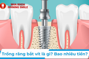 Trồng Răng Bắt Vít Giá Bao Nhiêu? Bảng Giá Mới Nhất!