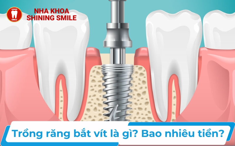 Răng Sứ Cercon: Sự Lựa Chọn Hoàn Hảo Cho Nụ Cười Hoàn Mỹ