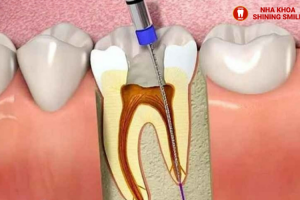 Lỡ Nuốt Mắc Cài Niềng Răng: Biện Pháp Xử Lý và Phòng Ngừa