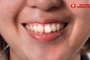Quy Trình Niềng Răng Hô Chi Tiết Từ A Đến Z