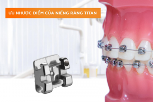Khám Phá Mắc Cài Damon: Công Nghệ và Lợi Ích Vượt Trội