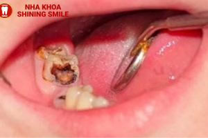 16 Tuổi Trồng Răng Được Không? Lời Khuyên Từ Bác Sĩ!