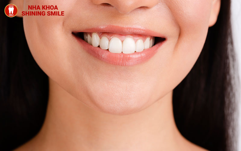 Có nên niềng răng không? Những điều bạn chưa biết về niềng răng