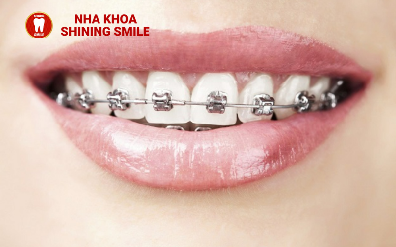 Bọc Răng Sứ Giá Bao Nhiêu? Tìm Hiểu Chi Phí Thực Tế Tại Nha Khoa