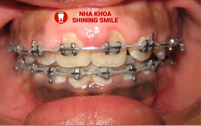 Niềng Răng Có Thể Uống Nước Đá Không?