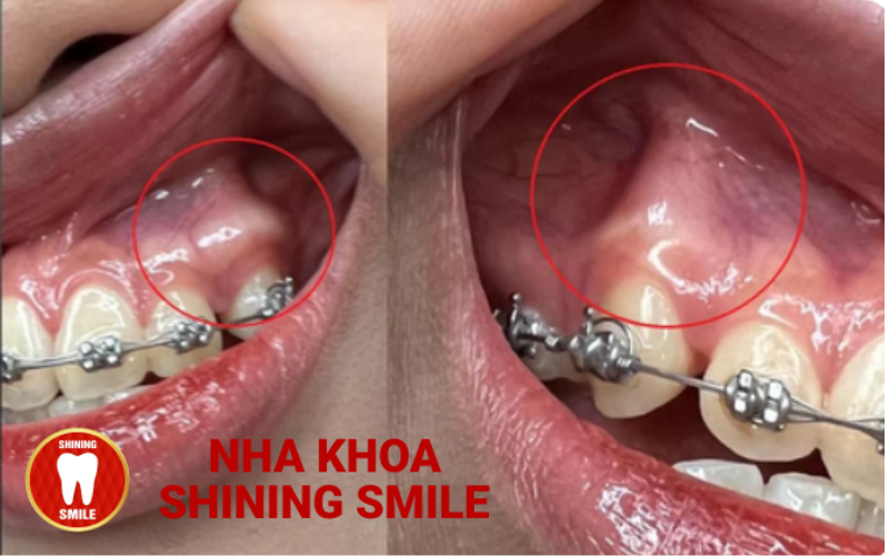 Bác Sĩ Cấy Implant Giỏi: Bí Quyết Chọn Đúng Người!