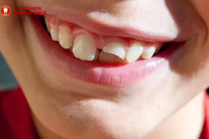 Góc thắc mắc: Hô hàm có niềng răng được không?