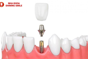 Nên chọn cầu răng sứ hay implant?