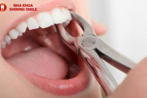 Nhổ Răng Cửa Bao Lâu Thì Trồng Lại Được? Tư Vấn Chi Tiết Từ Chuyên Gia