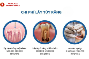 Diệt Tủy Răng Bao Nhiêu Tiền? Tiết Lộ Chi Phí Cập Nhật Mới Nhất