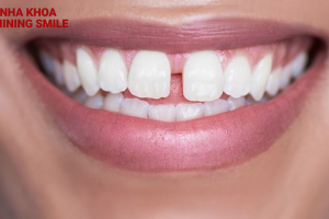 Có thể chỉ niềng 2 răng cửa được không?
