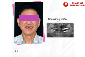 Thực đơn tối ưu cho người niềng răng