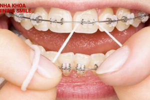 Mẹo Vệ Sinh Răng Niềng Hiệu Quả: Bí Quyết Giữ Răng Sạch Khỏe