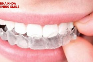 Tất Tần Tật Về Niềng Răng Tháo Lắp: Giải Pháp Hoàn Hảo Cho Nụ Cười Tự Tin