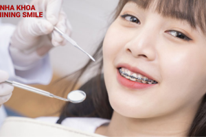Giá chi tiết cho câu hỏi 17 tuổi niềng răng bao nhiêu tiền