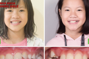 15 tuổi niềng răng hết bao nhiêu tiền? Các cách để tối ưu hóa chi phí