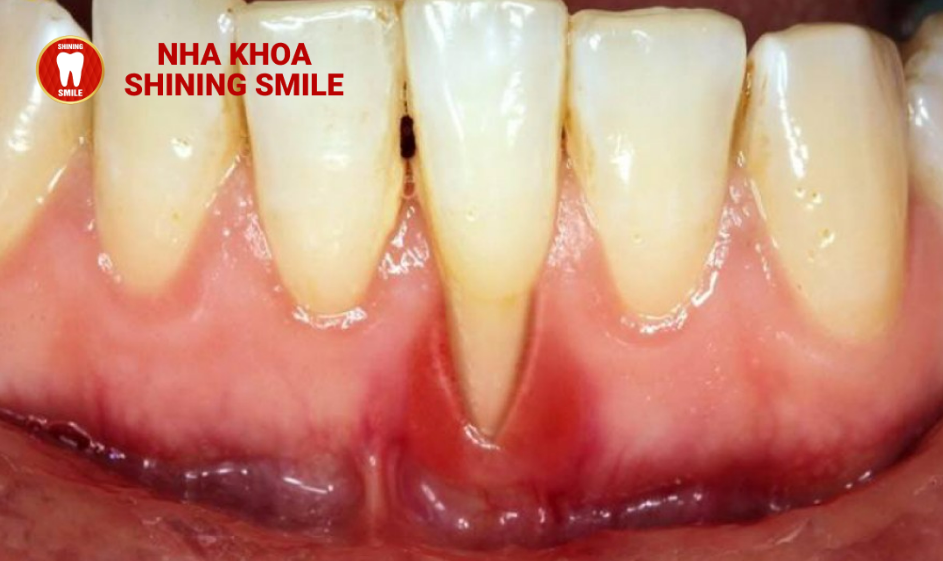 Niềng Răng Ở Tuổi 16: Thời Gian và Kết Quả Mong Đợi
