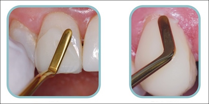 Trám cổ chân răng – Từ A-Z những thông tin bạn cần biết khi thực hiện 1