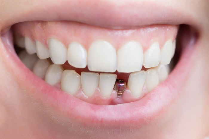 Trồng chân răng bằng phương pháp nào hiệu quả nhất? 2