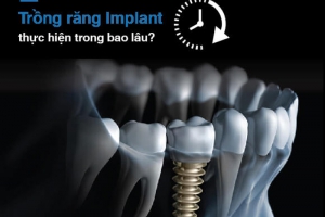 Trồng Răng Implant Bao Lâu Thì Lành? Bí Quyết Hồi Phục Nhanh!