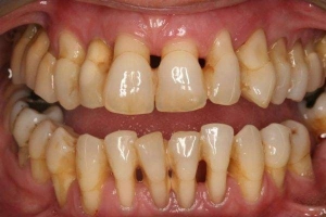 Phục Hình Toàn Hàm Trên Implant: Giải Pháp Hoàn Hảo Cho Bạn!