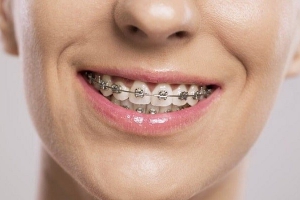 Có mấy loại mắc cài có thể sử dụng khi niềng răng?